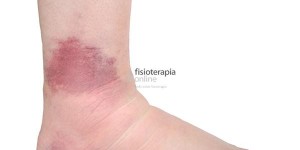 fisioterapia-online-esguince_tobillo-b_0